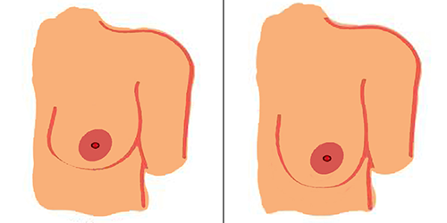 Best Breast Plastic surgeon Bangalore