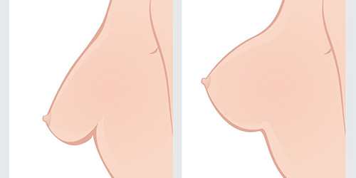 Best Breast Plastic surgeon Bangalore