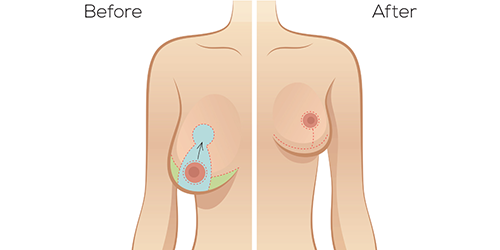 Best Breast Plastic surgeon Bangalore