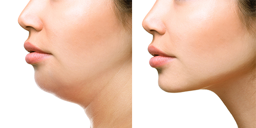 Face plastic surgery bangalore