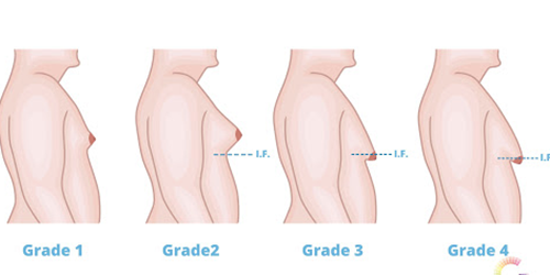 Best Breast Plastic surgeon Bangalore