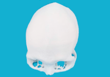 Best Craniosynostosis Surgery