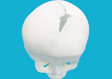 Best Craniosynostosis Surgery