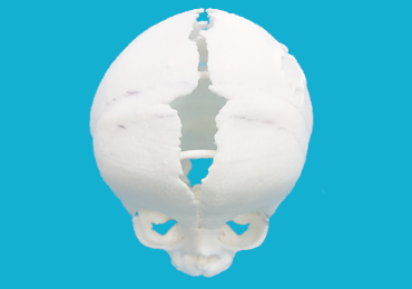 Best Craniosynostosis Surgery